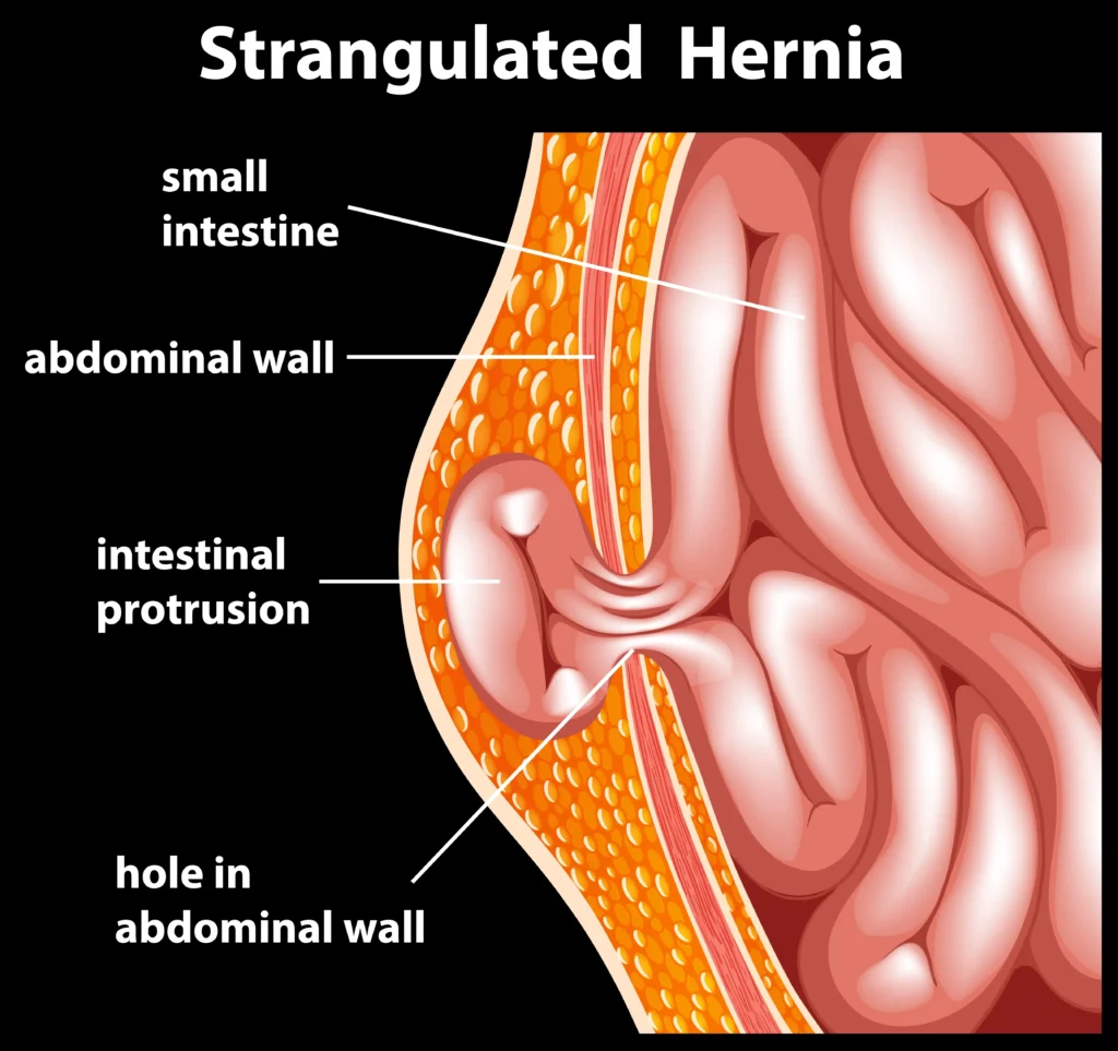 Direct and Indirect Hernia